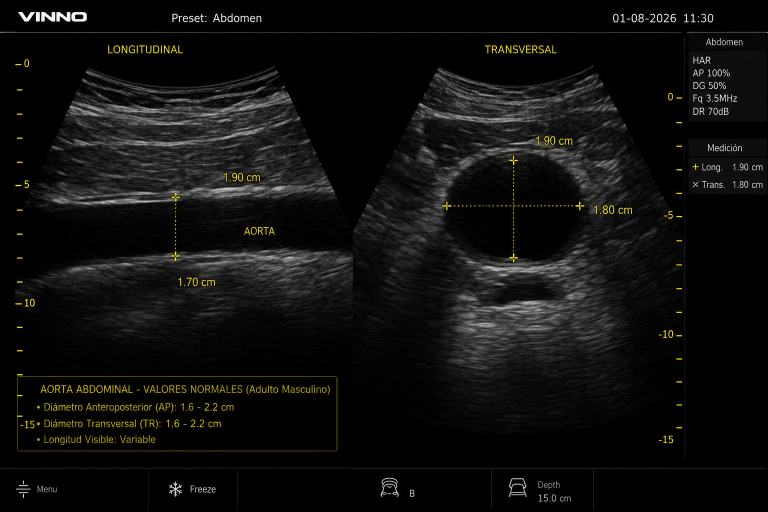 Ecografía normal de aorta abdominal