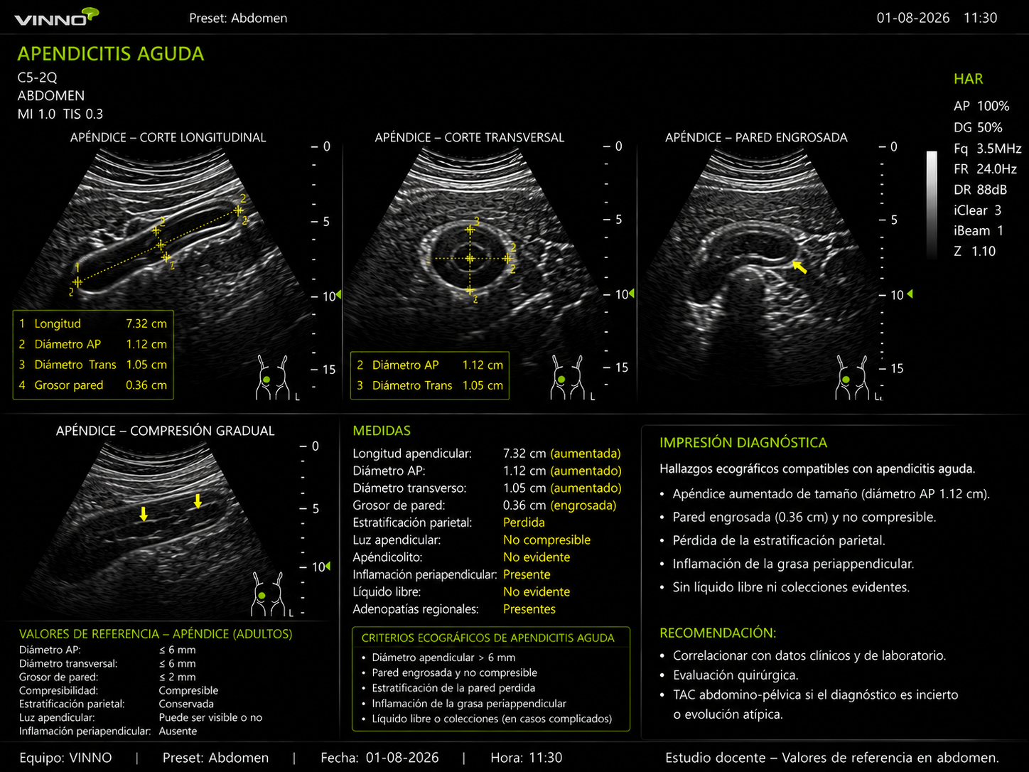 Apendicitis aguda