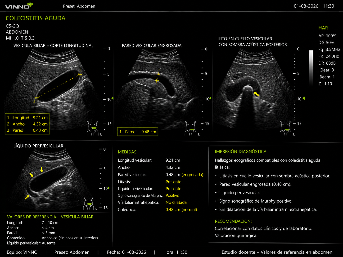 Colecistitis aguda
