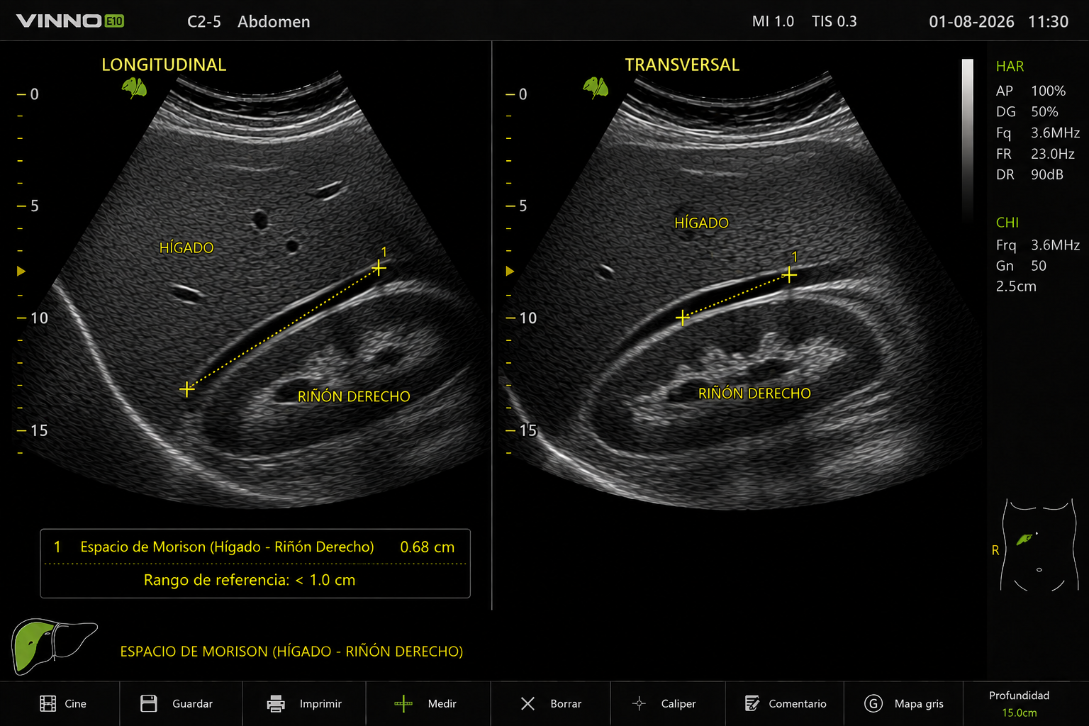 Ventana hepatorrenal de Morison