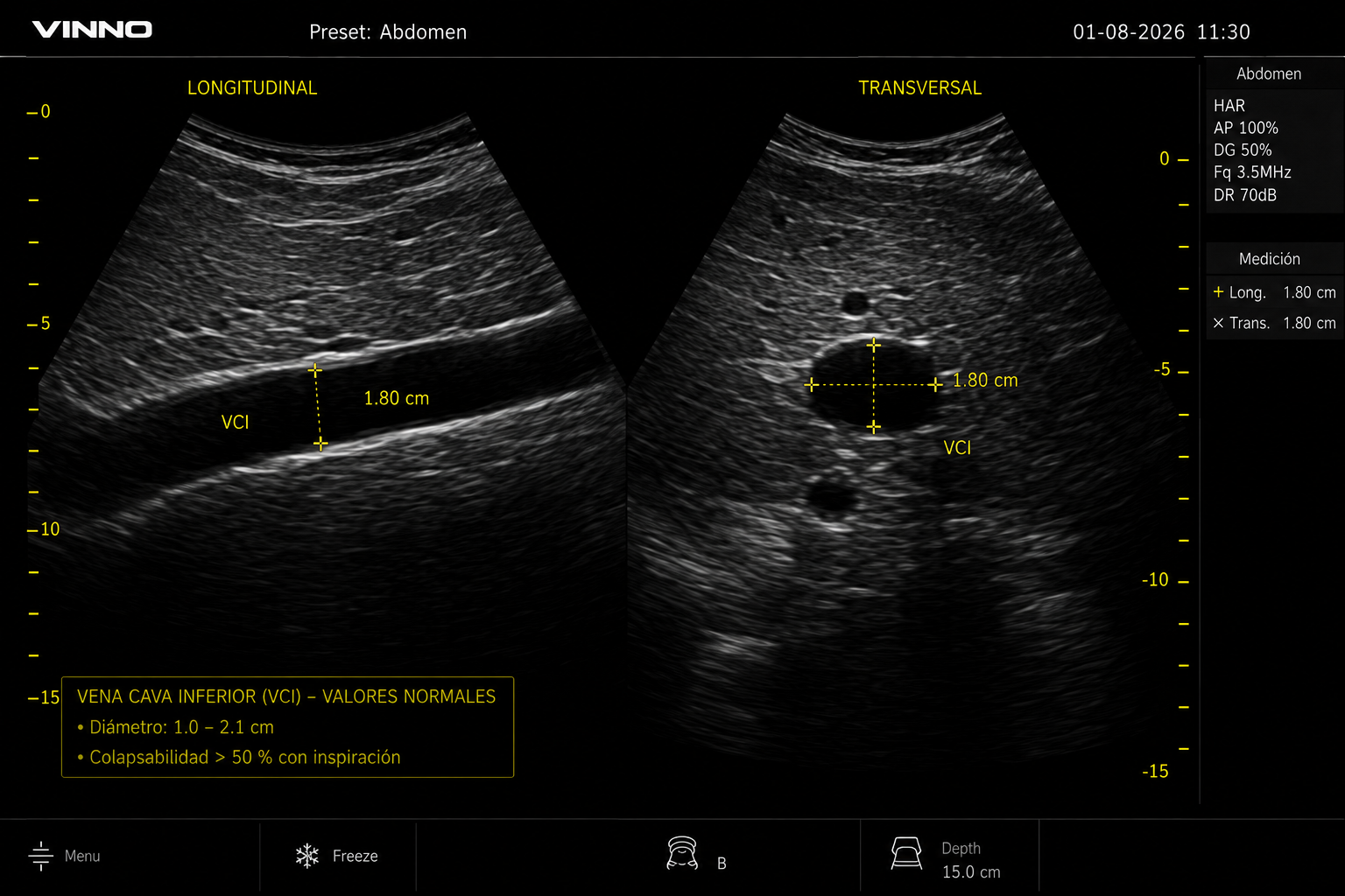 Ecografía normal de vena cava inferior