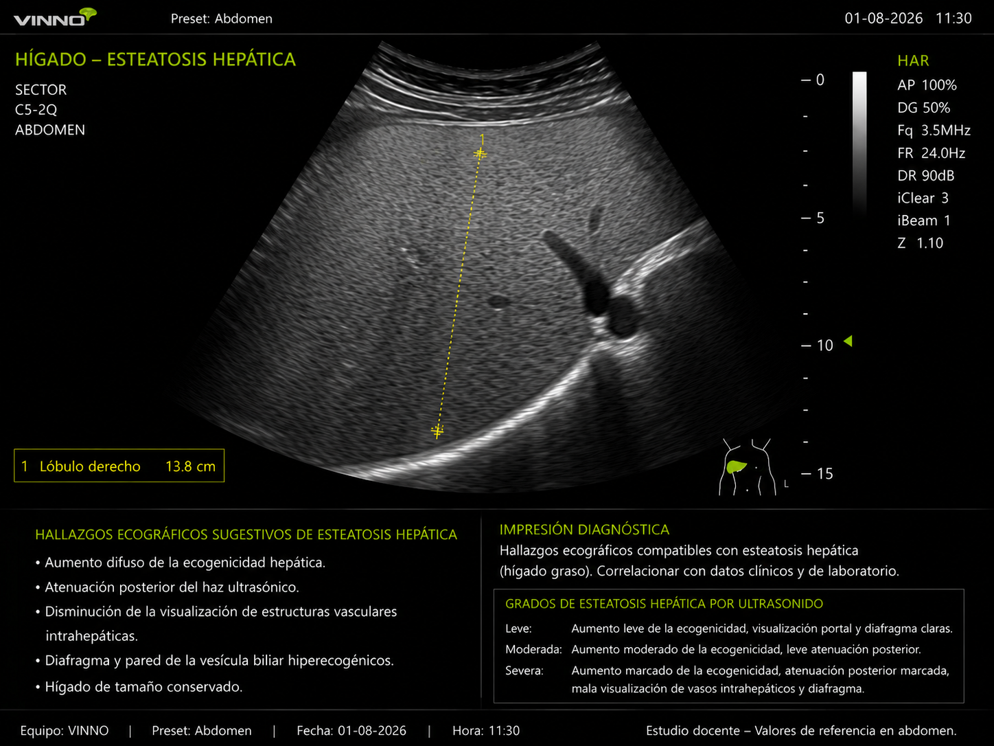 Esteatosis hepática