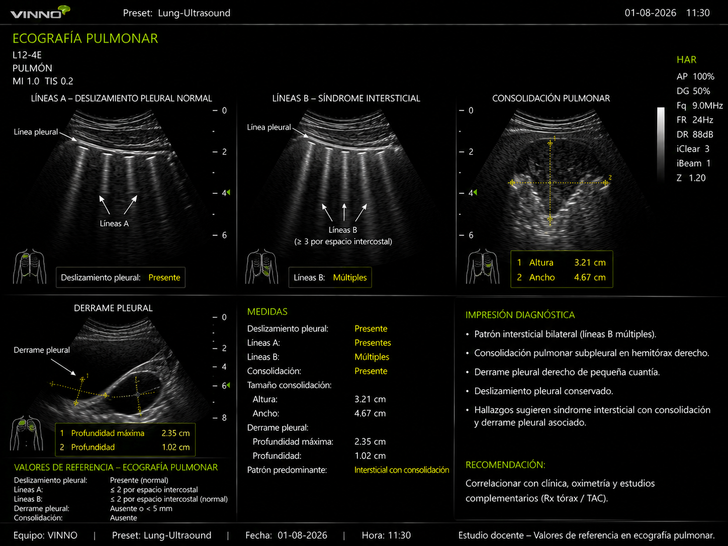 Ecografía pulmonar
