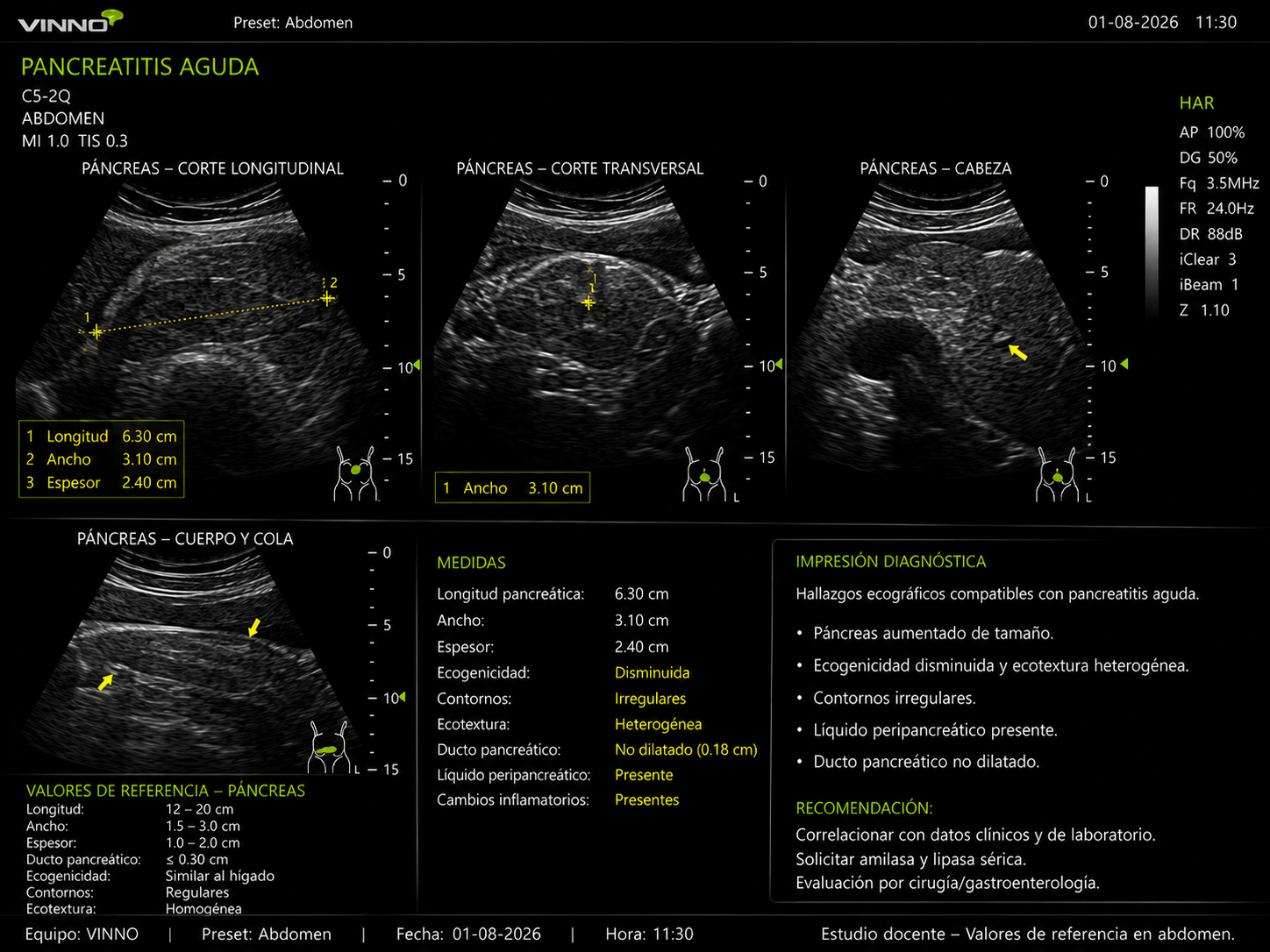 Pancreatitis aguda