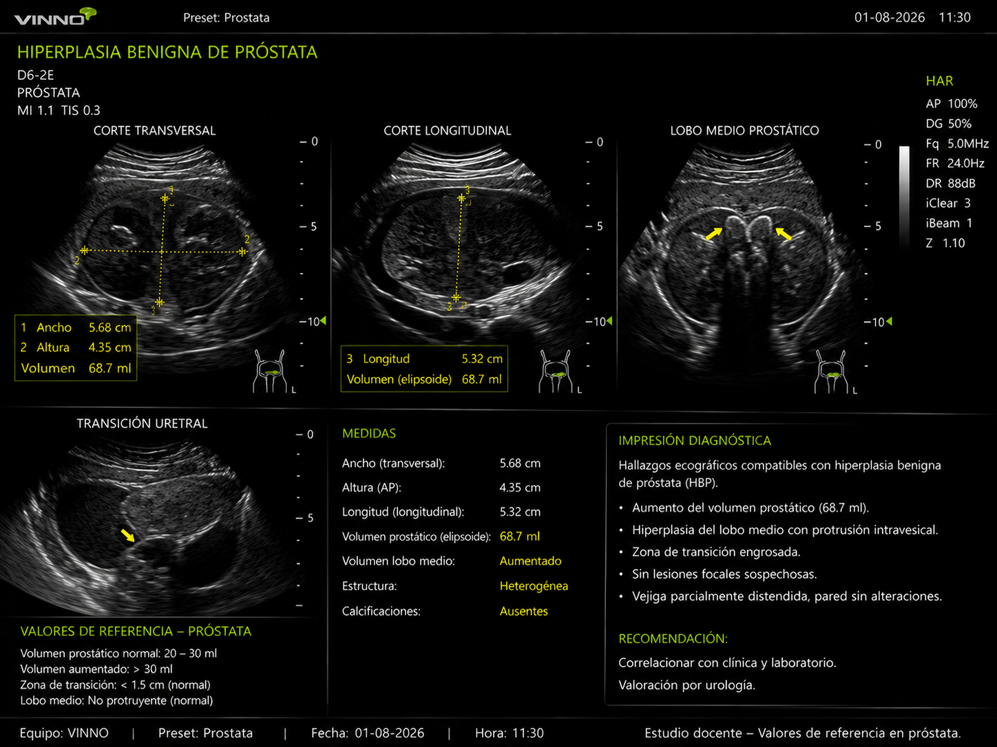 Hiperplasia prostática benigna