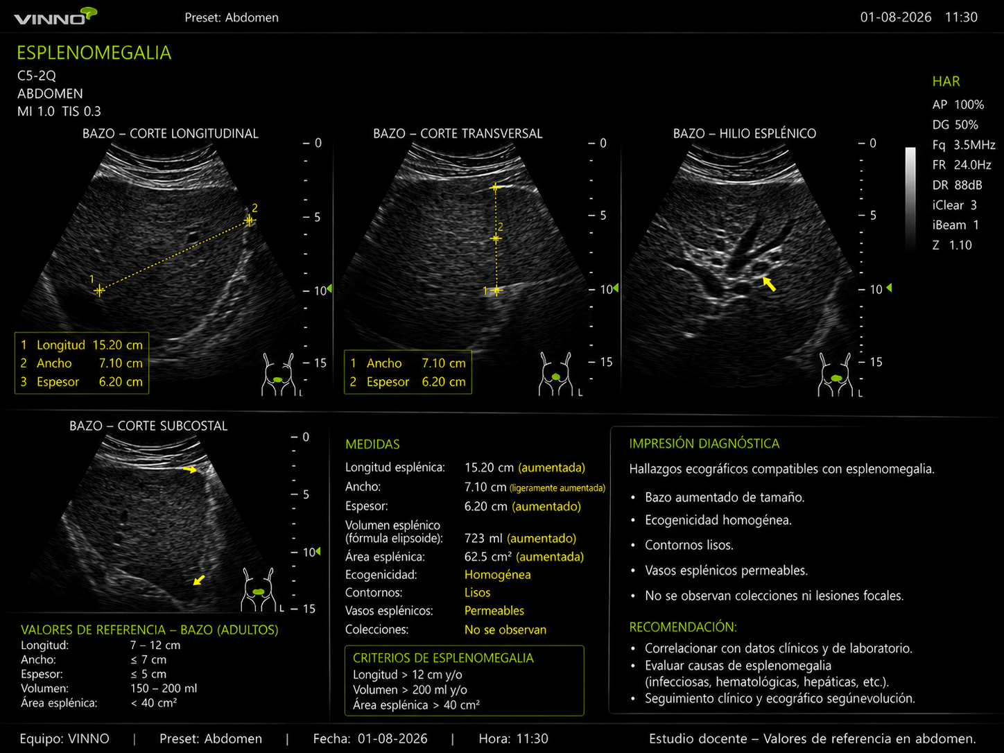 Esplenomegalia